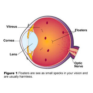 Eye Floaters Healthy Vision Treatments For Eye Spots