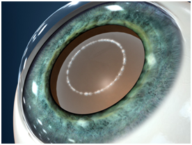 cataract surgery procedure