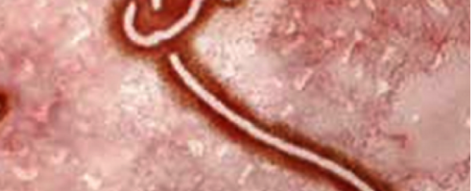 Ebola Virus Causes & Symptoms