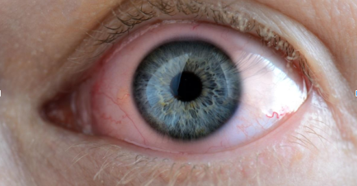 Ocular Rosacea & Vision Health Problems